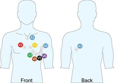 Extended ECG Improves Classification of Paroxysmal and Persistent Atrial Fibrillation Based on P- and f-Waves